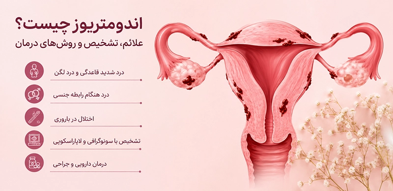 تصویر آموزشی درباره علائم و درمان اندومتریوز در زنان