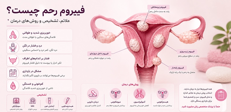 تصویر آموزشی درباره علائم، تشخیص و درمان فیبروم رحم
