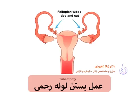 عمل-بستن-لوله-رحم-در-کرج